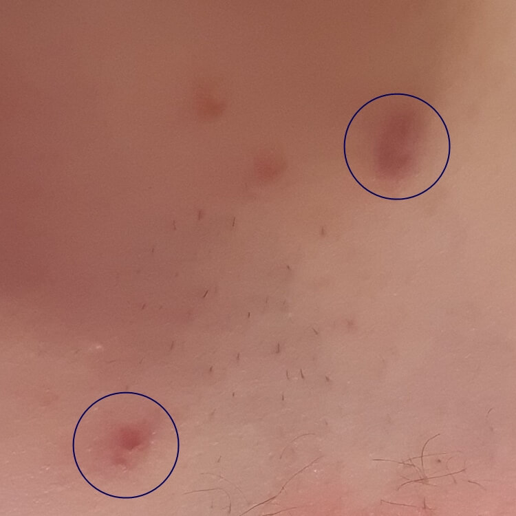 Small lumps under the skin