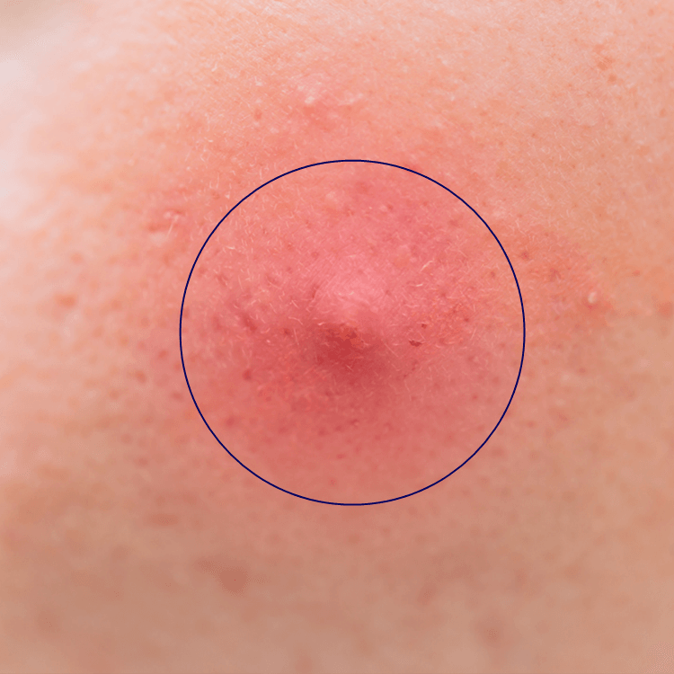 Follicular occlusion