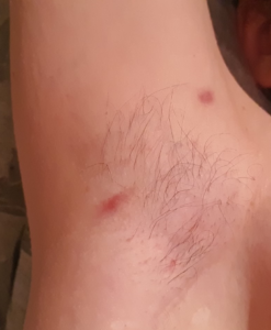 hs armpit stage 1