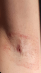 hs armpit stage 2