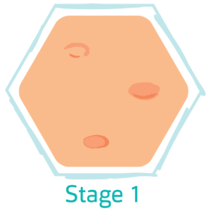 hs stage 1