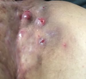 HS Wounds
